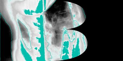 Schwarzweiss Ultraschall aufnahme eines Uterus, überlagert am rechten Rand von einer schwarzen Fläche, sodass aus dem Schwarweissbild der Buchstabe B entseht.